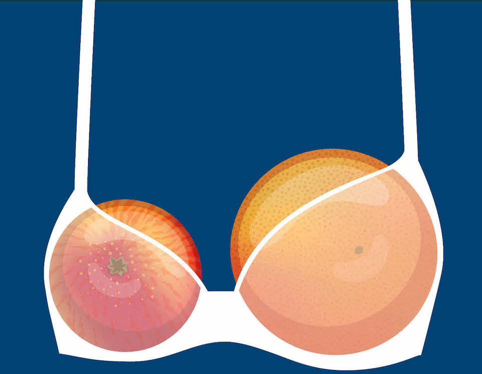 Seios assimétricos ... não é a coisa mais fácil de abordar, Mas existe solução